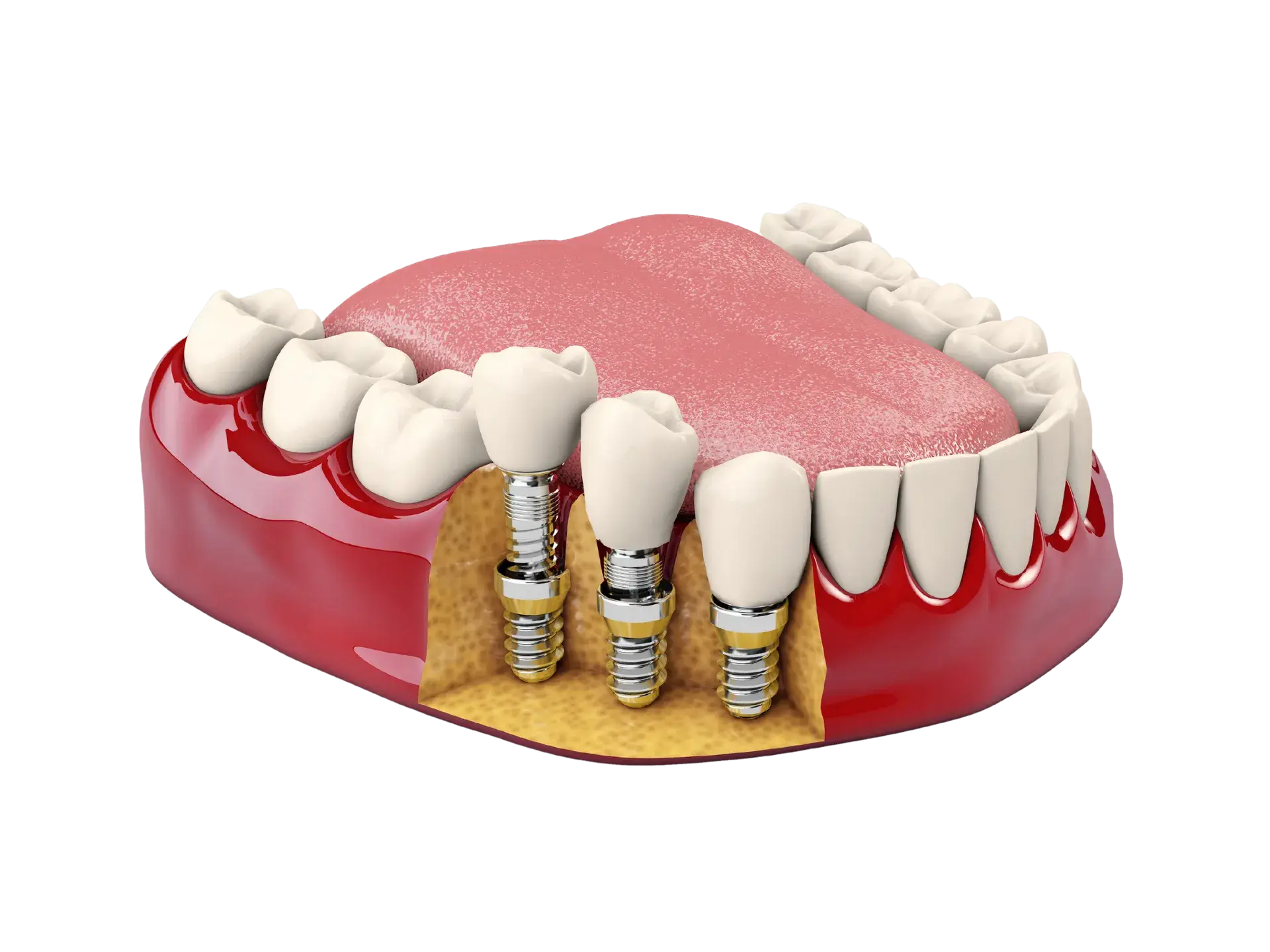 Implant Model