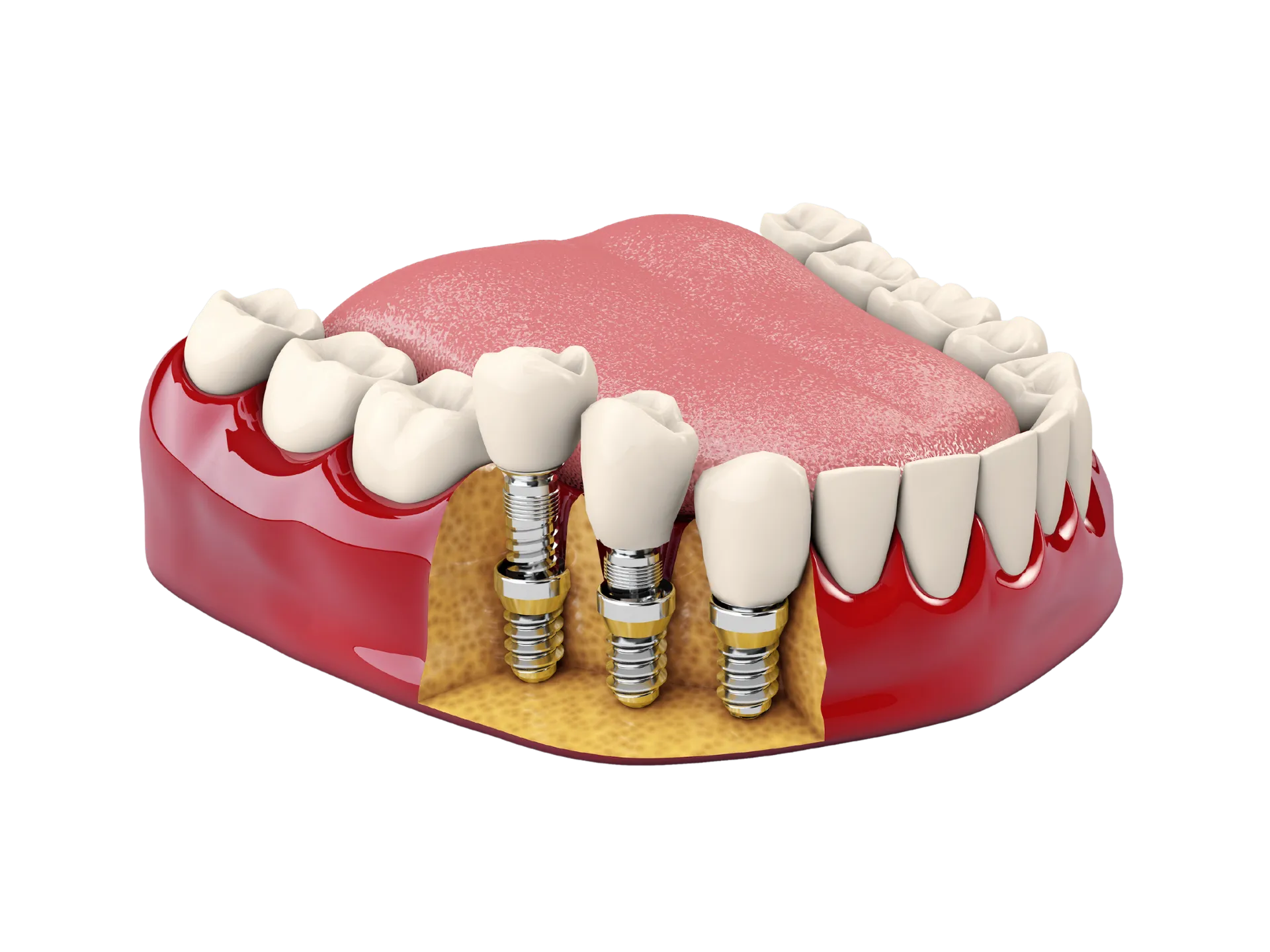 Implant model placeholder